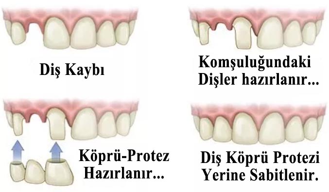 KÖPRÜ DİŞ TEDAVİSİ