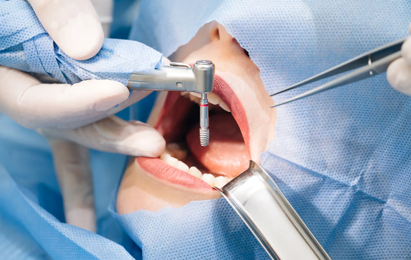 İMPLANT TEDAVİSİ